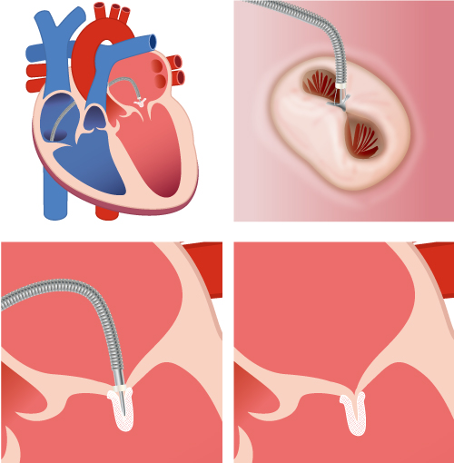 経皮的僧帽弁接合不全修復術
