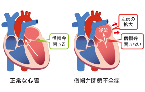 僧帽弁閉鎖不全症