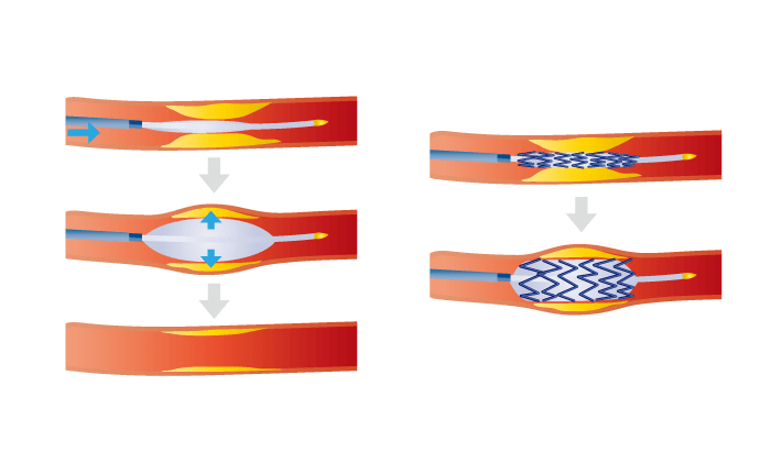 冠動脈インターベンション 左：バルーン形成術 右：ステント留置術