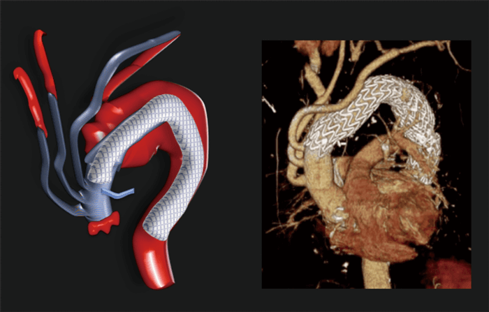 人工血管とステントグラフト