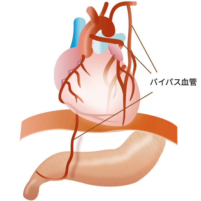 冠動脈バイパス術