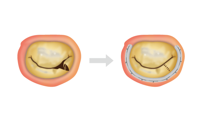 僧帽弁形成術 左：三角切除　右：リング縫着