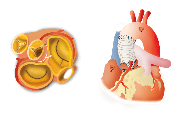 左：単独大動脈弁形成術／右：自己弁温存大動脈基部置換術（リモデリング）