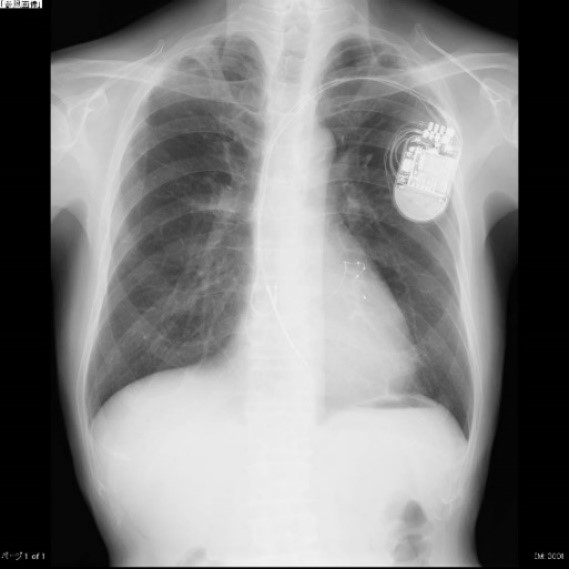 両心室ペーシング機能付き植込型除細動器移植術(X線撮影)