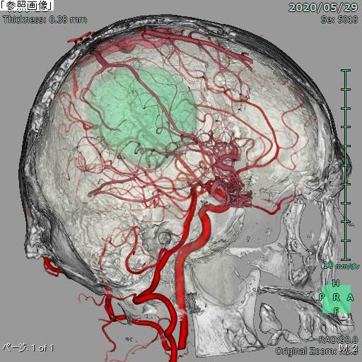 CT、MRIの画像と血管撮影での造影画像を重ね合わせた3D画像