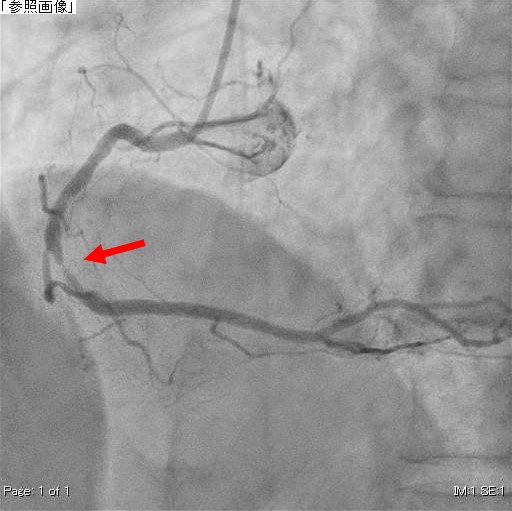 右冠動脈造影（治療前）
