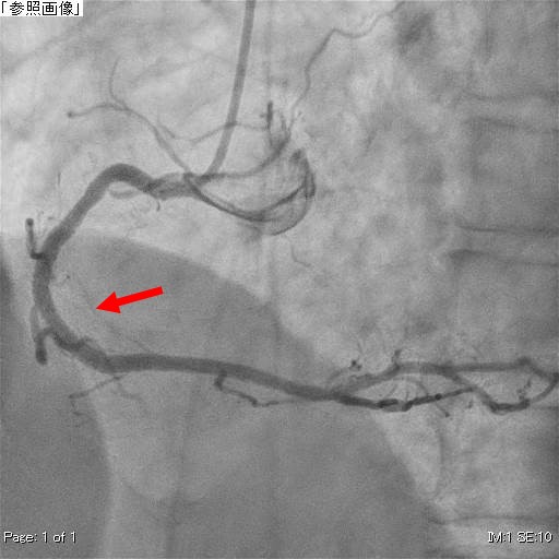 右冠動脈造影（PCI後）