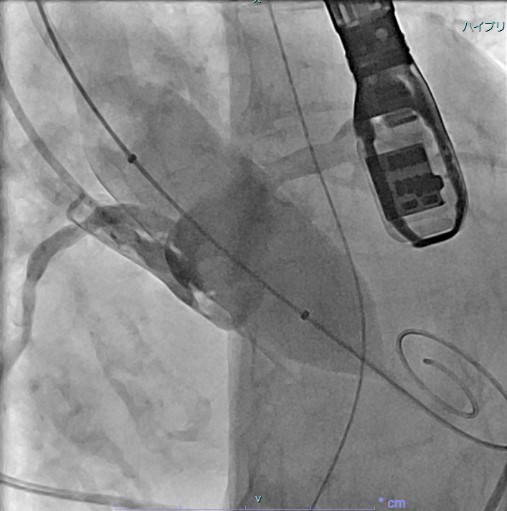 大動脈弁狭窄症(BAV施行時の大動脈造影)