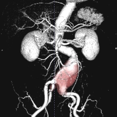 腹部大動脈瘤術前CT