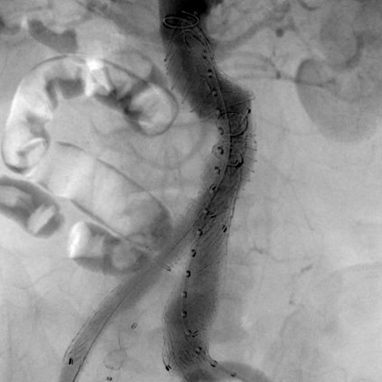 大動脈造影 ステントグラフト内挿術後