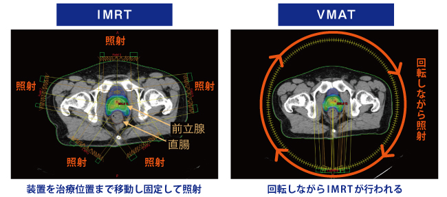 IMRTとVMAT