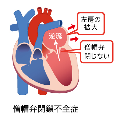 僧帽弁閉鎖不全症