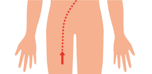 鼠径部からカテーテルを挿入の図