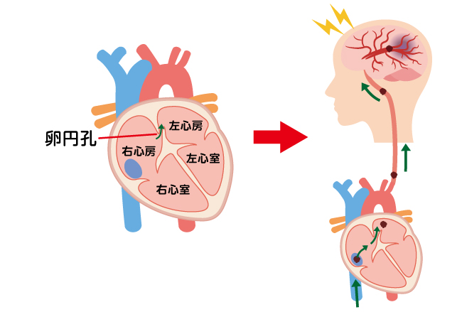 卵円孔開存症と脳梗塞の説明図