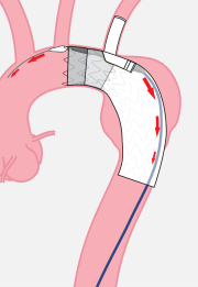 弓部大動脈瘤にステントグラフトを展開している画像