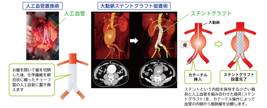 〈図1〉腹部大動脈瘤の治療