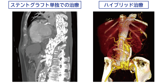 〈図3〉胸腹部大動脈瘤の治療