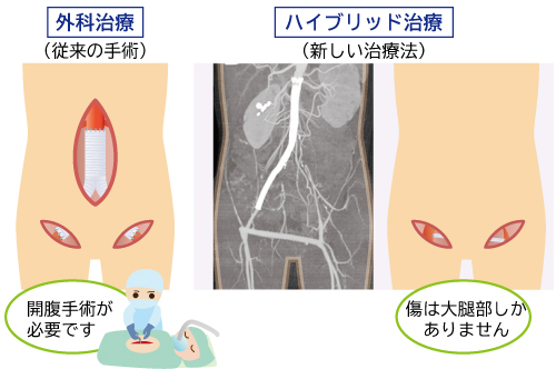 〈図6〉大動脈閉塞に対する外科治療とハイブリッド治療