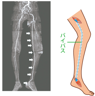 〈図7〉足底動脈へのバイパス手術