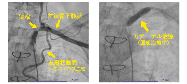 左鎖骨下静脈の狭窄とカテーテル治療（風船治療）