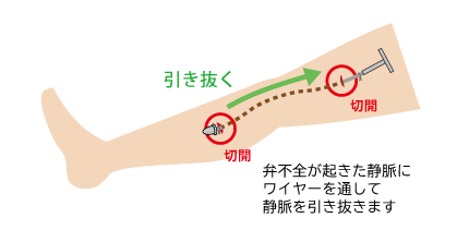 静脈瘤抜去切除術