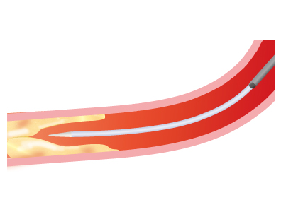 カテーテル治療