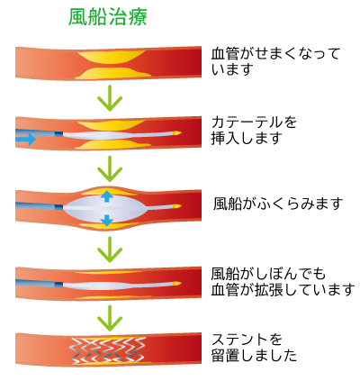 風船治療