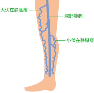 下肢静脈瘤