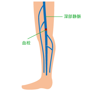 深部静脈血栓症