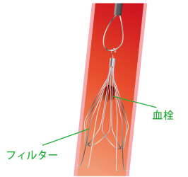 フィルターと血栓