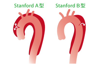 Stanford A型とStanford B型
