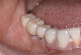 同症例の上部構造作製後の口腔内 （後方の3本がインプラント）