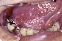 白板症を伴う舌・口底癌