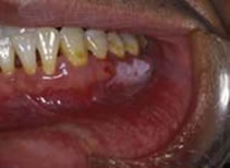 下顎歯肉白板症