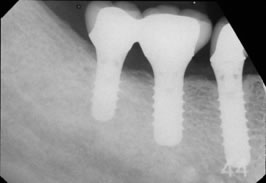 右下顎臼歯部のインプラント症例
