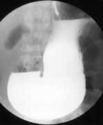 バリウムによる胃の造影写真
