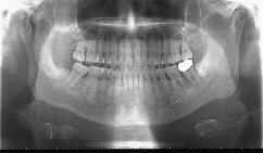 上下顎のパノラマ断層写真