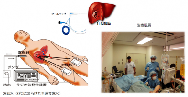 ラジオ波焼灼療法