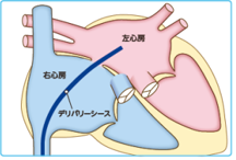 経皮的卵円孔開存閉鎖術の説明図