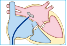 経皮的卵円孔開存閉鎖術の説明図