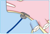 経皮的卵円孔開存閉鎖術の説明図