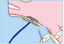 経皮的卵円孔開存閉鎖術の説明図