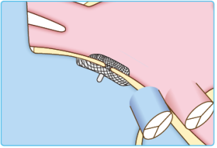 経皮的卵円孔開存閉鎖術の説明図